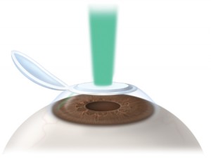 cornea1